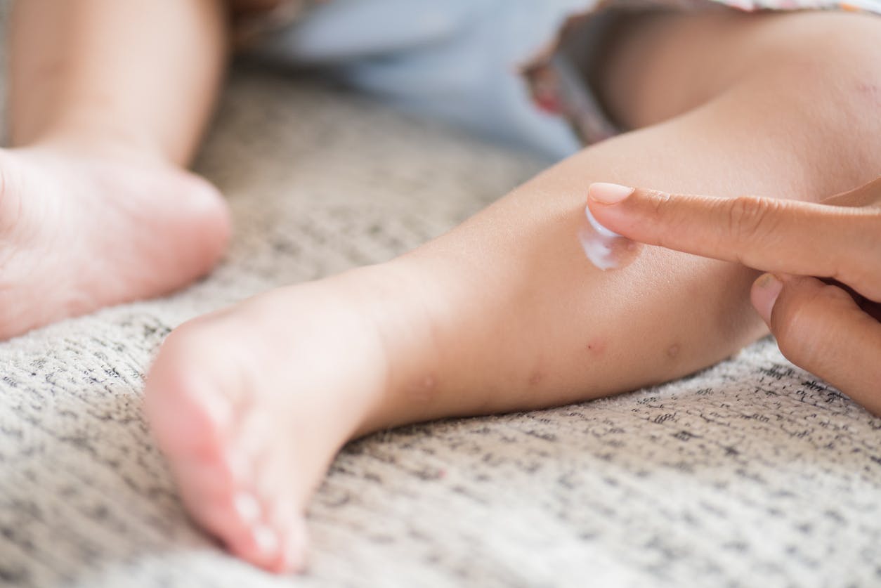 Piqûres de moustiques chez le bébé : comment gérer ?